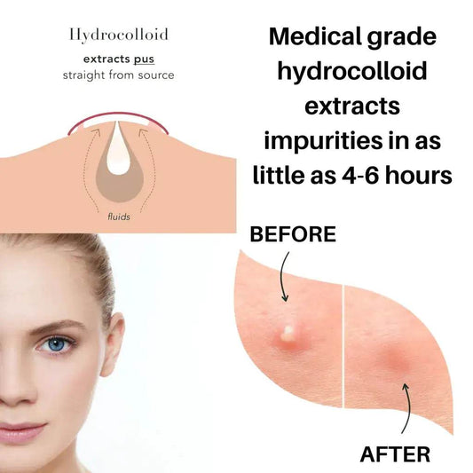 Glow In The Dark Hydrocolloid Acne Pimple Patches 36 Count - Get To Find It, LLC