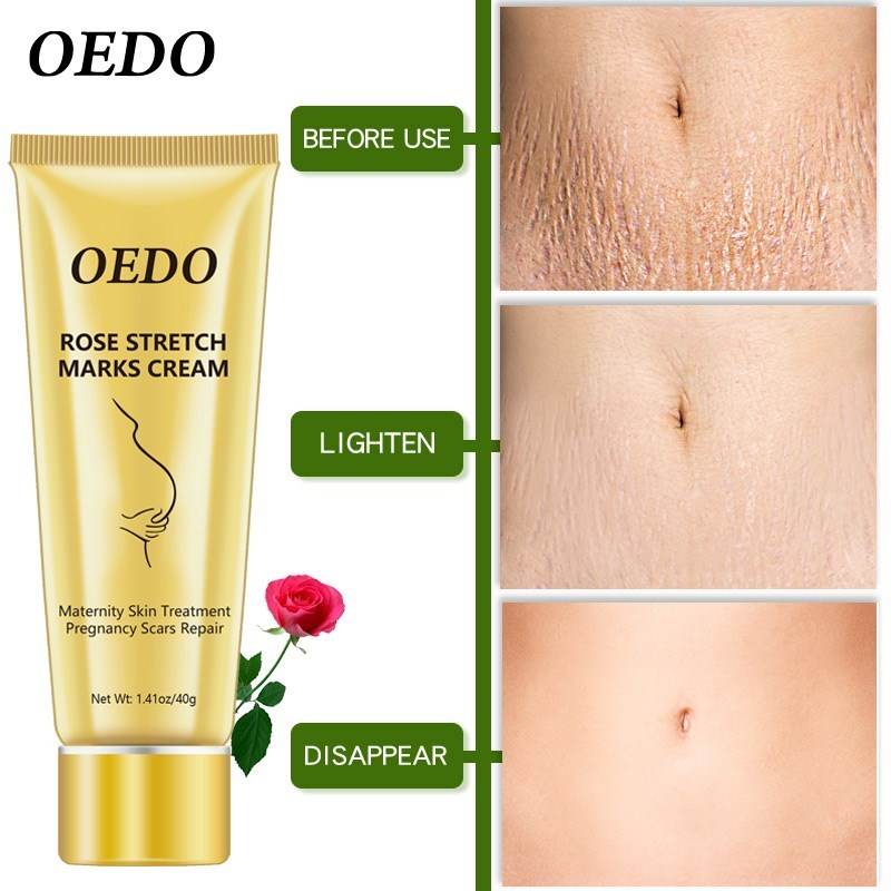 Stretch Mark Cream - Get To Find It, LLC