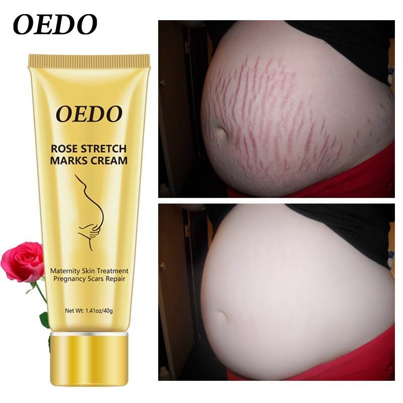 Stretch Mark Cream - Get To Find It, LLC